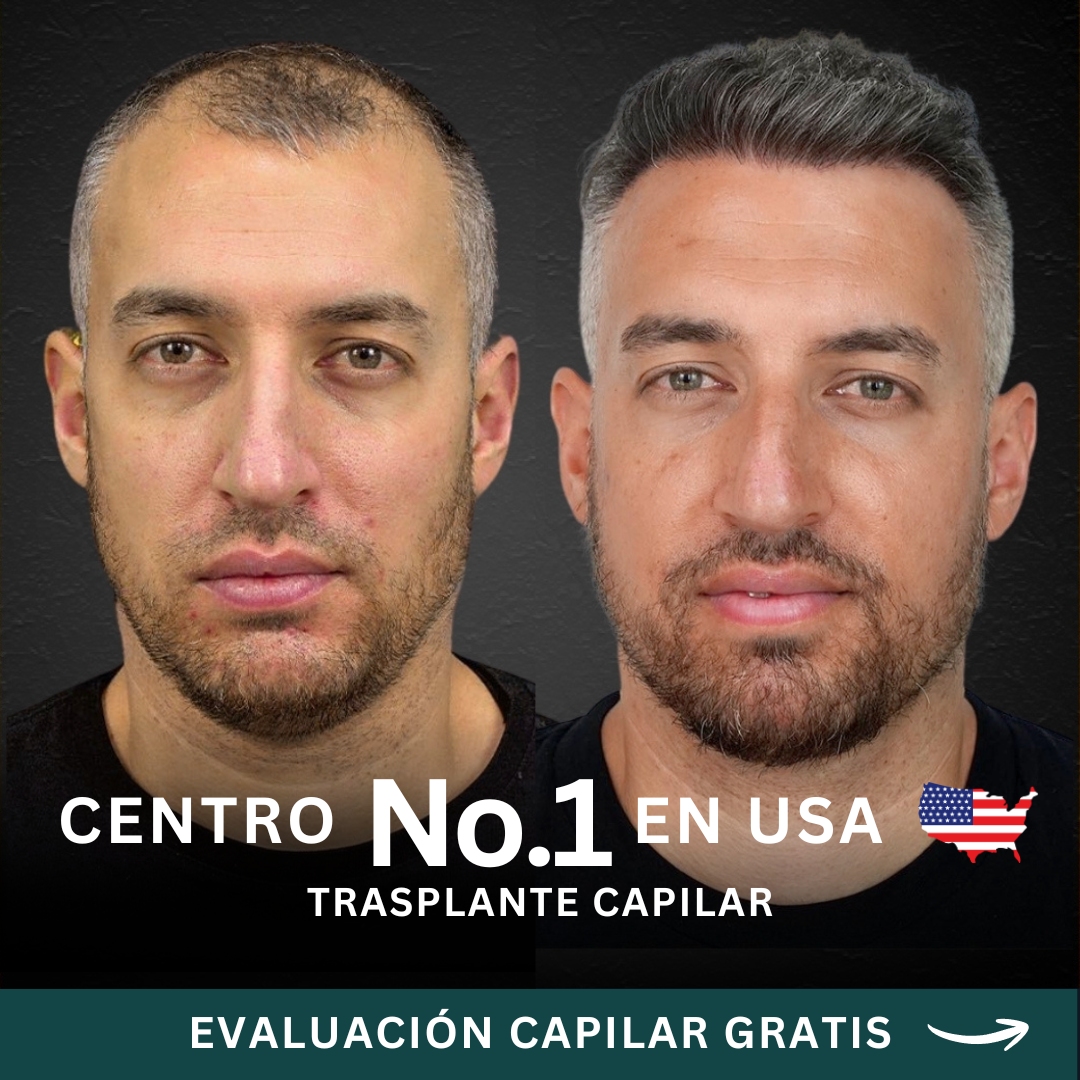 Hair Transplant Design Facebook ad