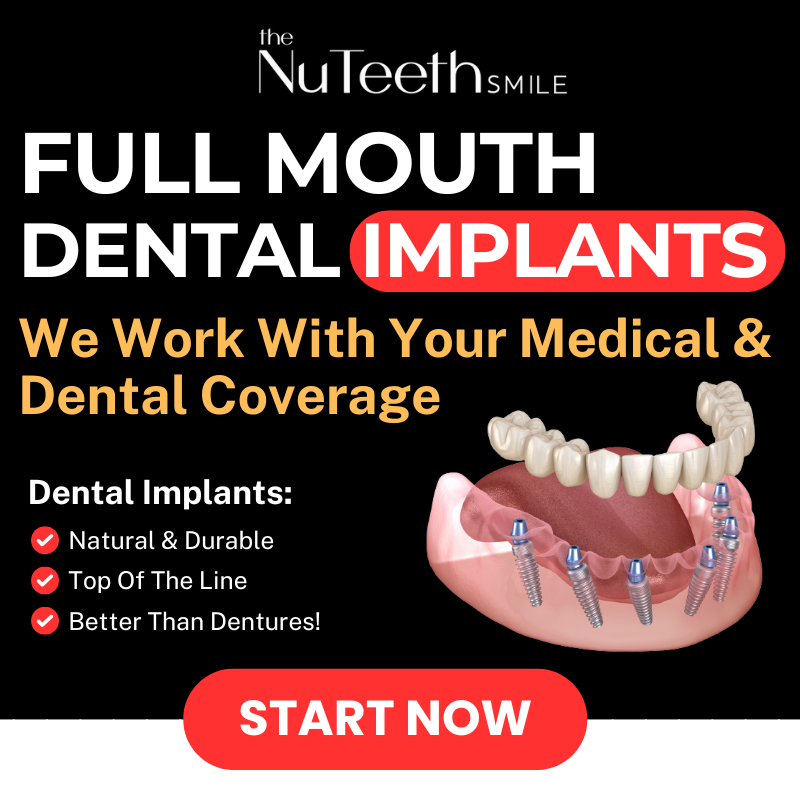 NuTeeth Dental Implant Center Facebook ad: All On 6 Full Mouth Dental Implants!