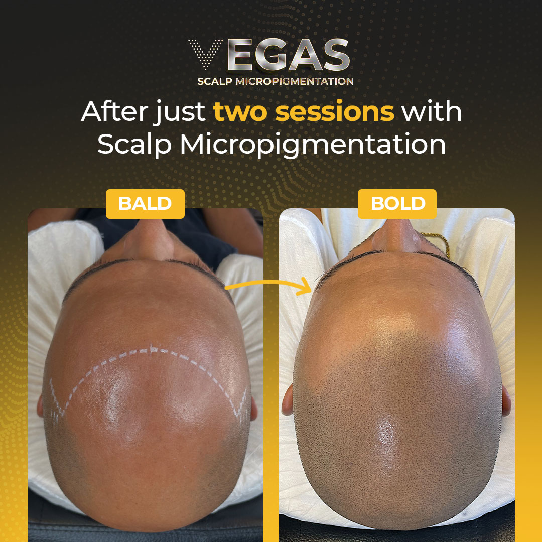 Vegas Scalp Micropigmentation Facebook ad: Las Vegas Hair Loss Solution, Award Winning SMP