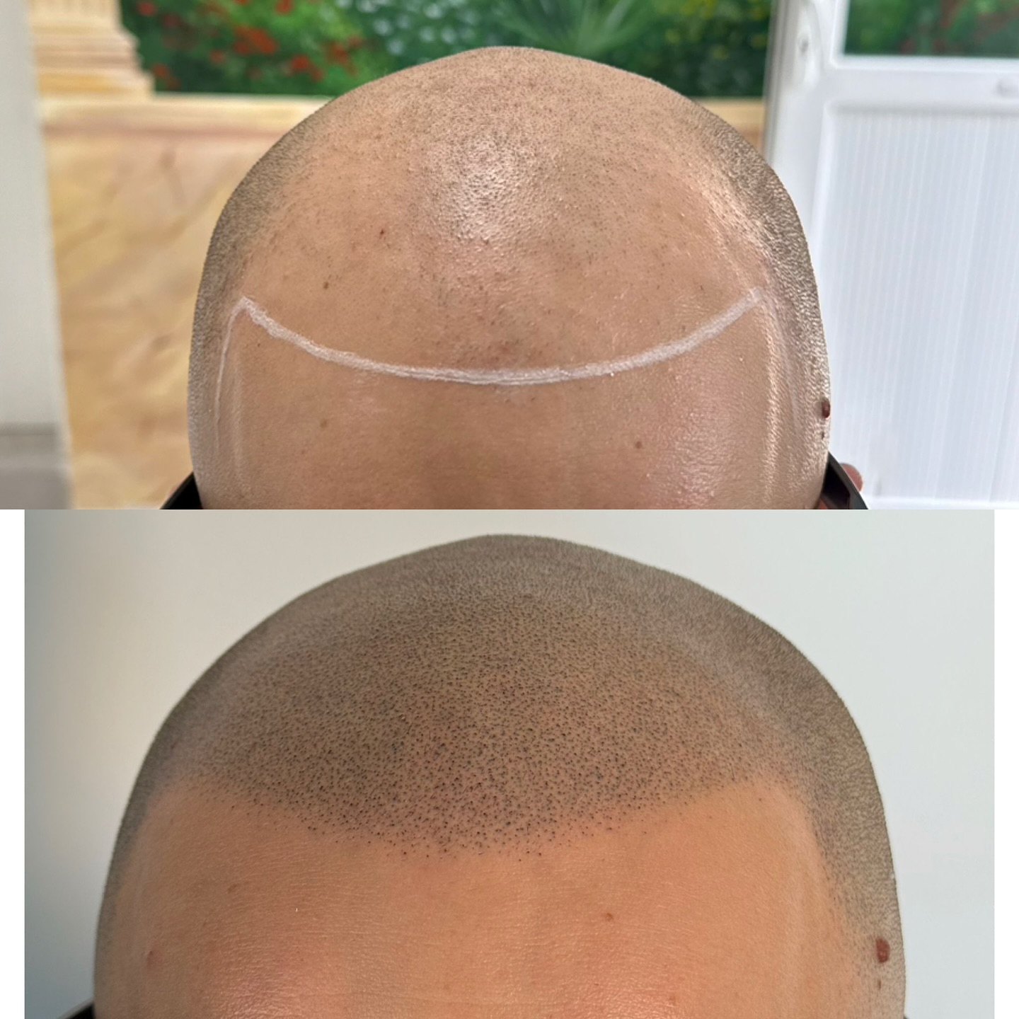 Micropigmentation Capillaire by. Idriss Soum Facebook ad