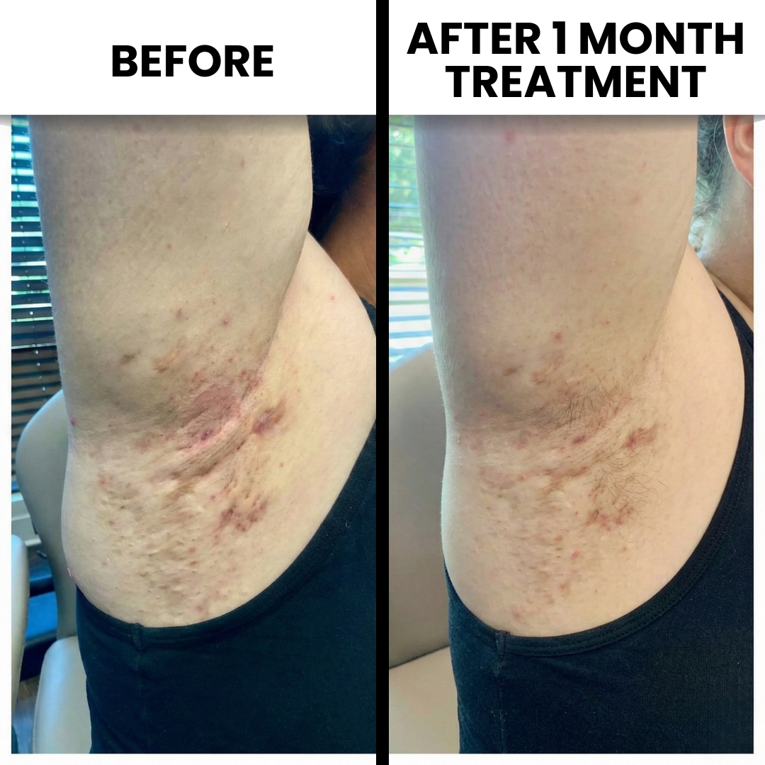Sarah Brown Facebook ad: Read If You Suffer From Hidradenitis Suppurativa (HS)
