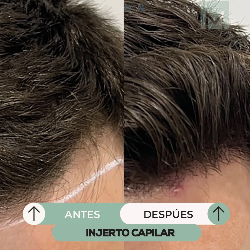 Medical Skin Clinic Facebook ad: Recupera tu cabello con injerto capilar