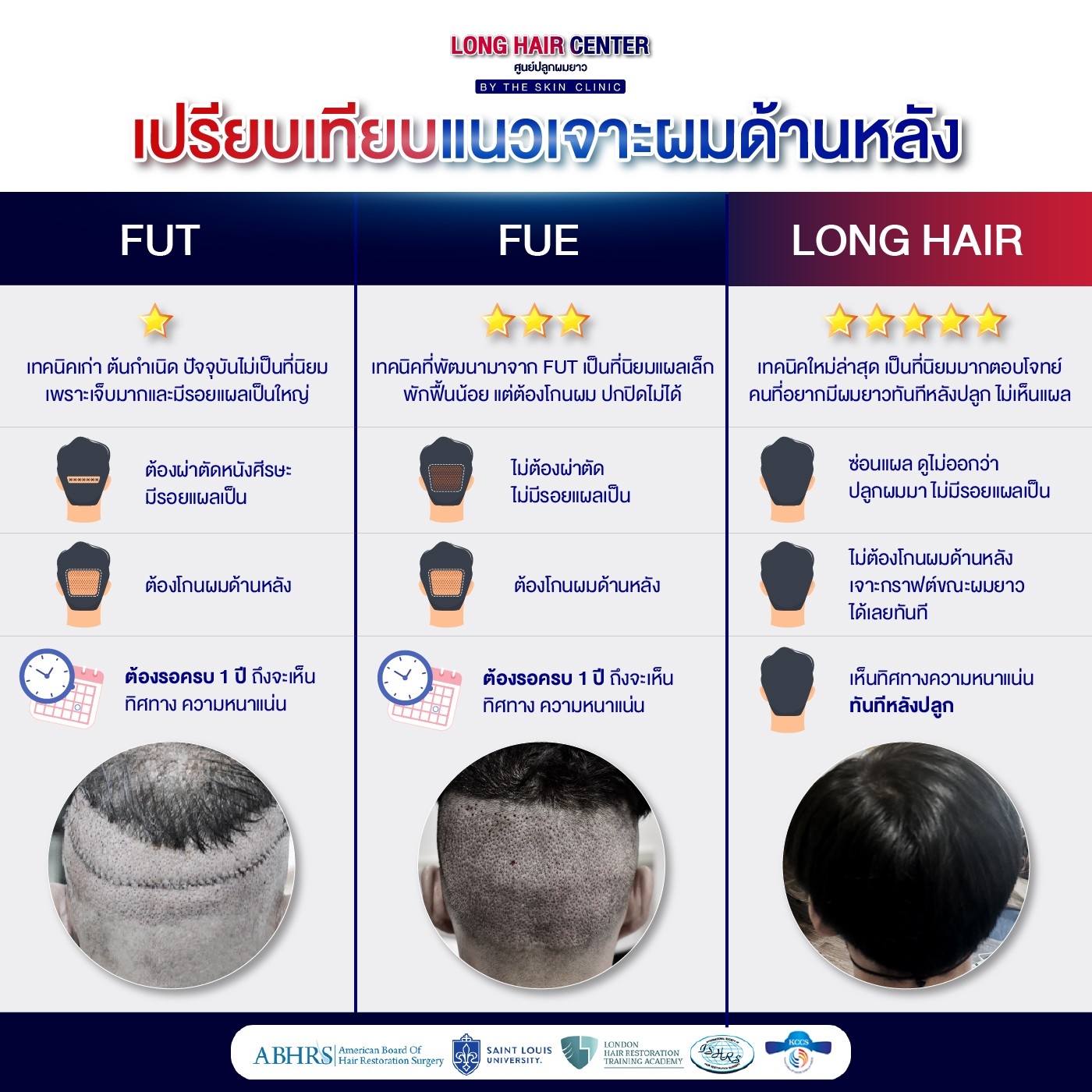 ปลูกผม Long Hair โดย หมอท็อป The skin clinic แพทย์อเมริกันบอร์ด Facebook ad