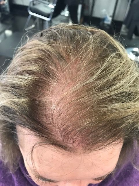 Lilly Bennett Facebook ad: The Window To Save Your Hair Is Smaller Than You Think