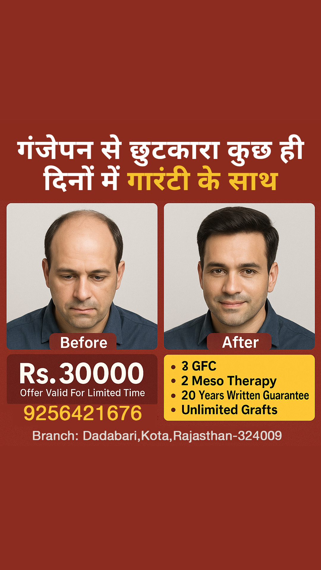 Best hair Transplant in Rajsthan-Udaypur-Kota,Jodhpur,Jaipur Facebook ad