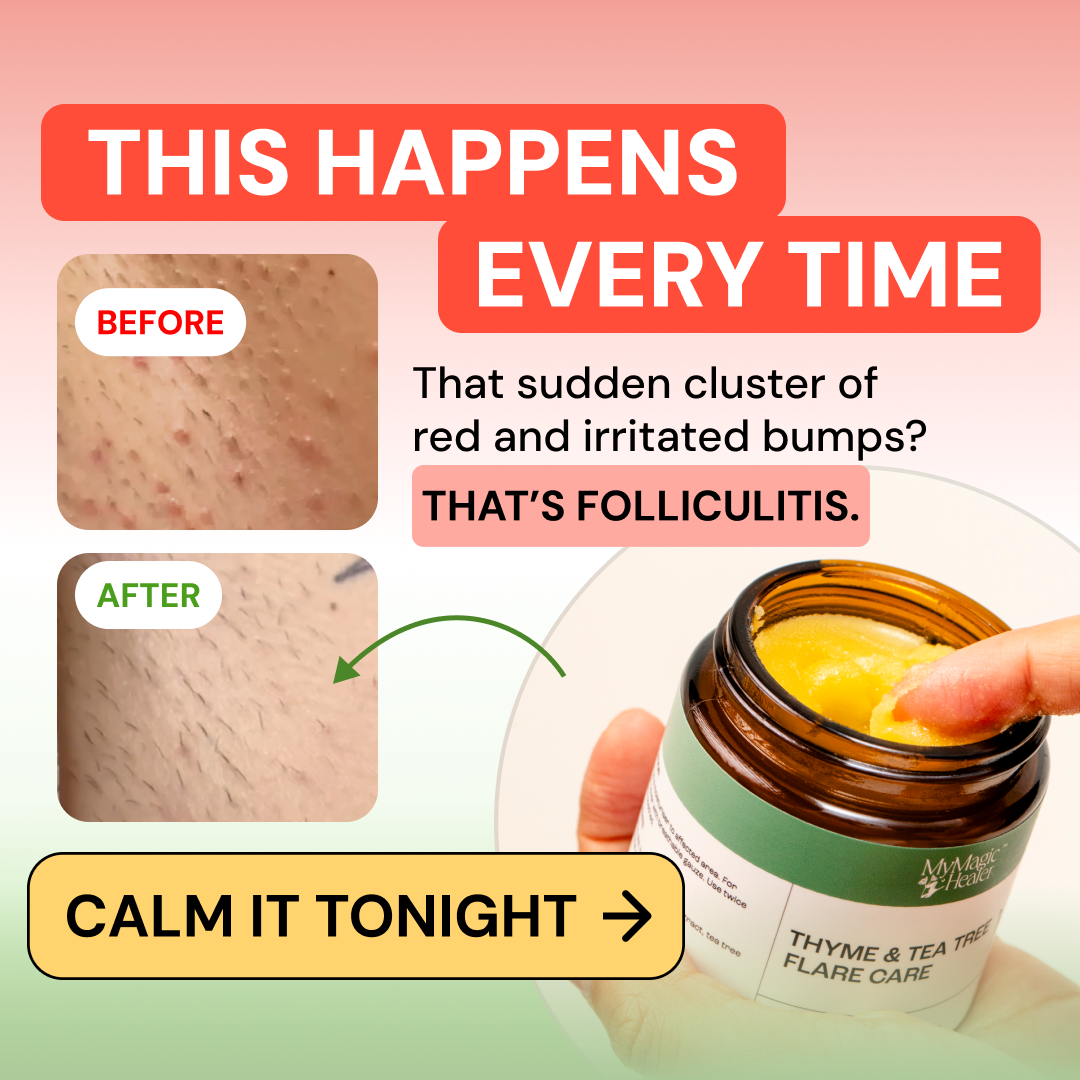 Mymagichealer Facebook ad: Bye Bye Folliculitis
