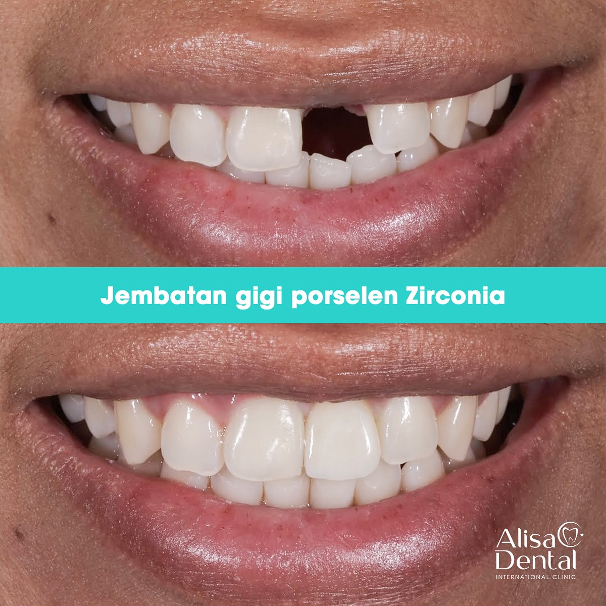 Alisa Dental International Clinic Facebook ad: UNGKAP 3 JENIS PORSELEN TERBAIK UNTUK JEMBATAN GIGI…
