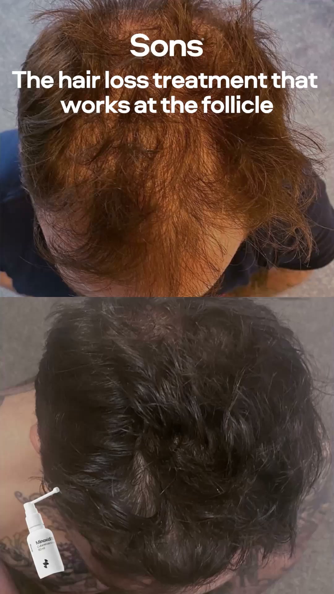 Sons Facebook ad: Your hairline. Your call.