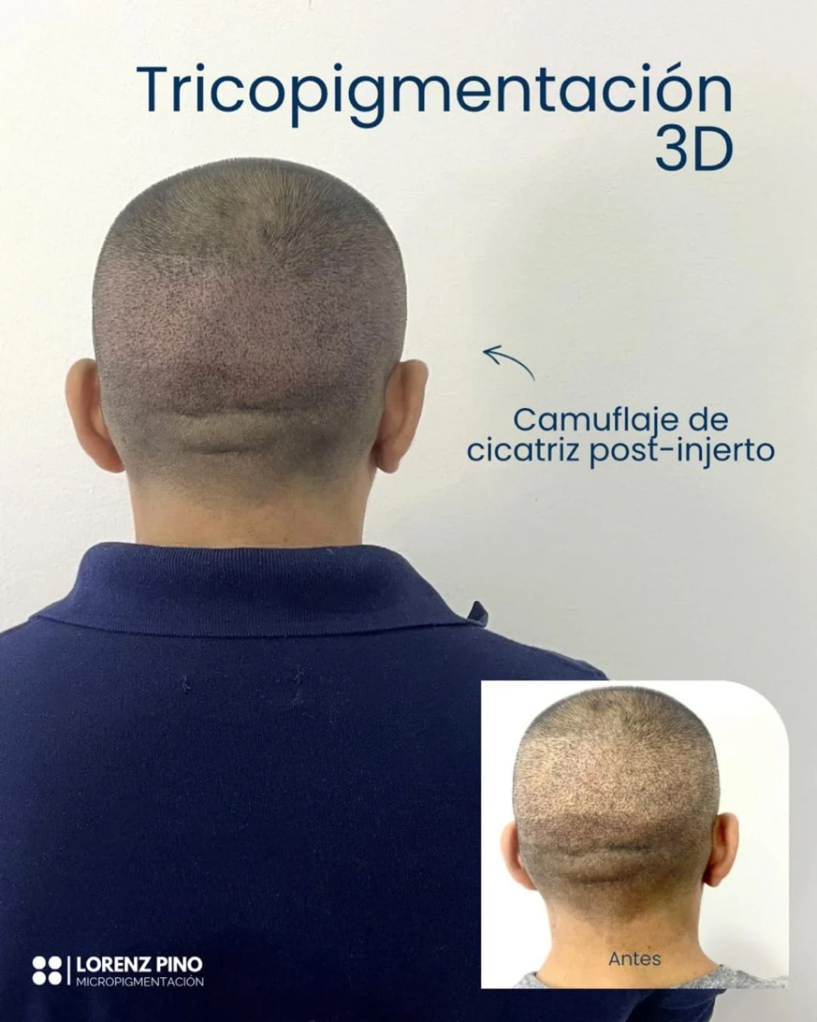 Lorenz Pino Facebook ad: La cicatriz de un injerto capilar no tiene…