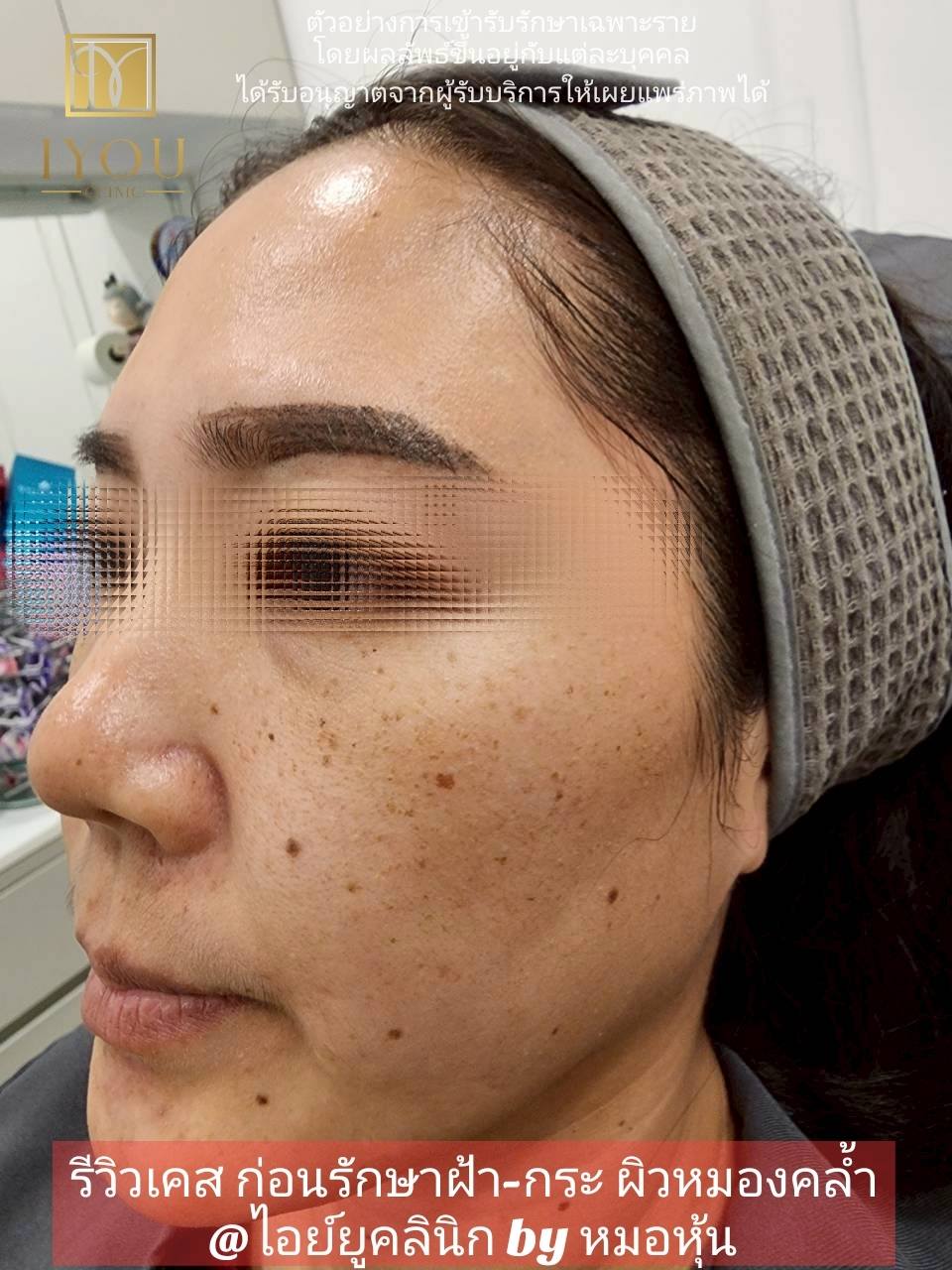 IYOU Clinic ไอย์ยูคลินิก ฉะเชิงเทรา by หมอหุ้น Facebook ad