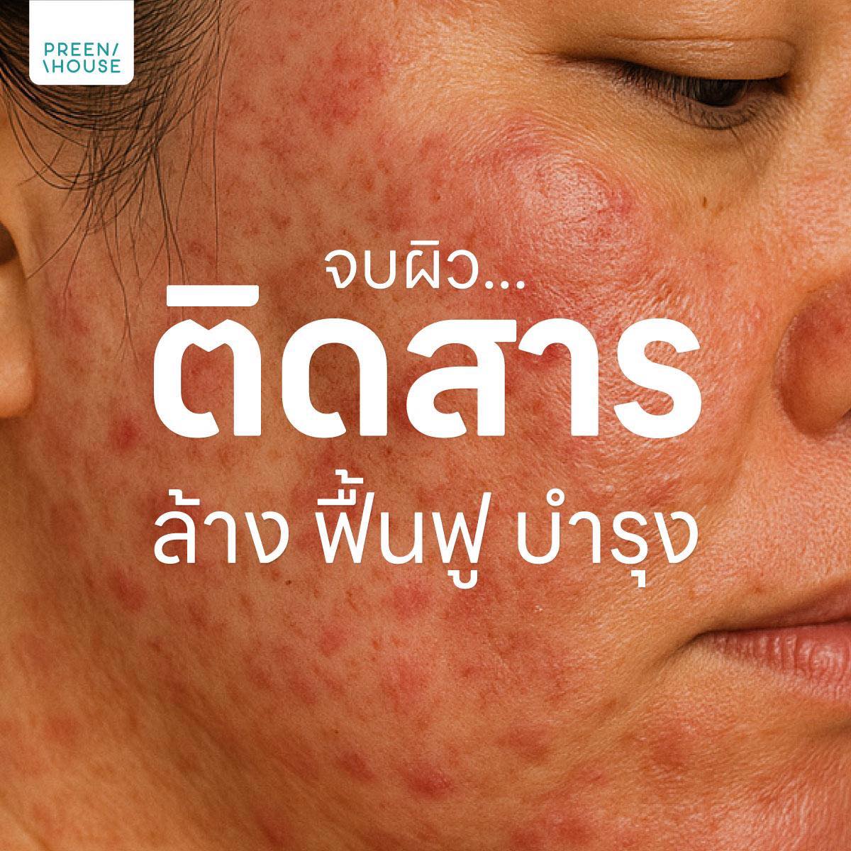 Preenhouse Thailand Facebook ad: ฝ้าด่างขาว | ฝ้าสารเคมี | ผิวติดสาร | ผิวดื้อครีม