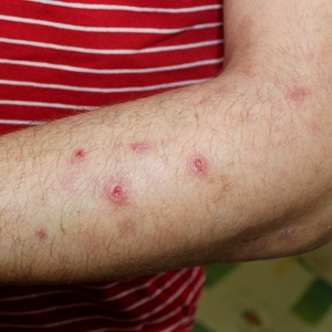 Info Paragon Spark Facebook ad: Apremilast Psoriasis Medications.