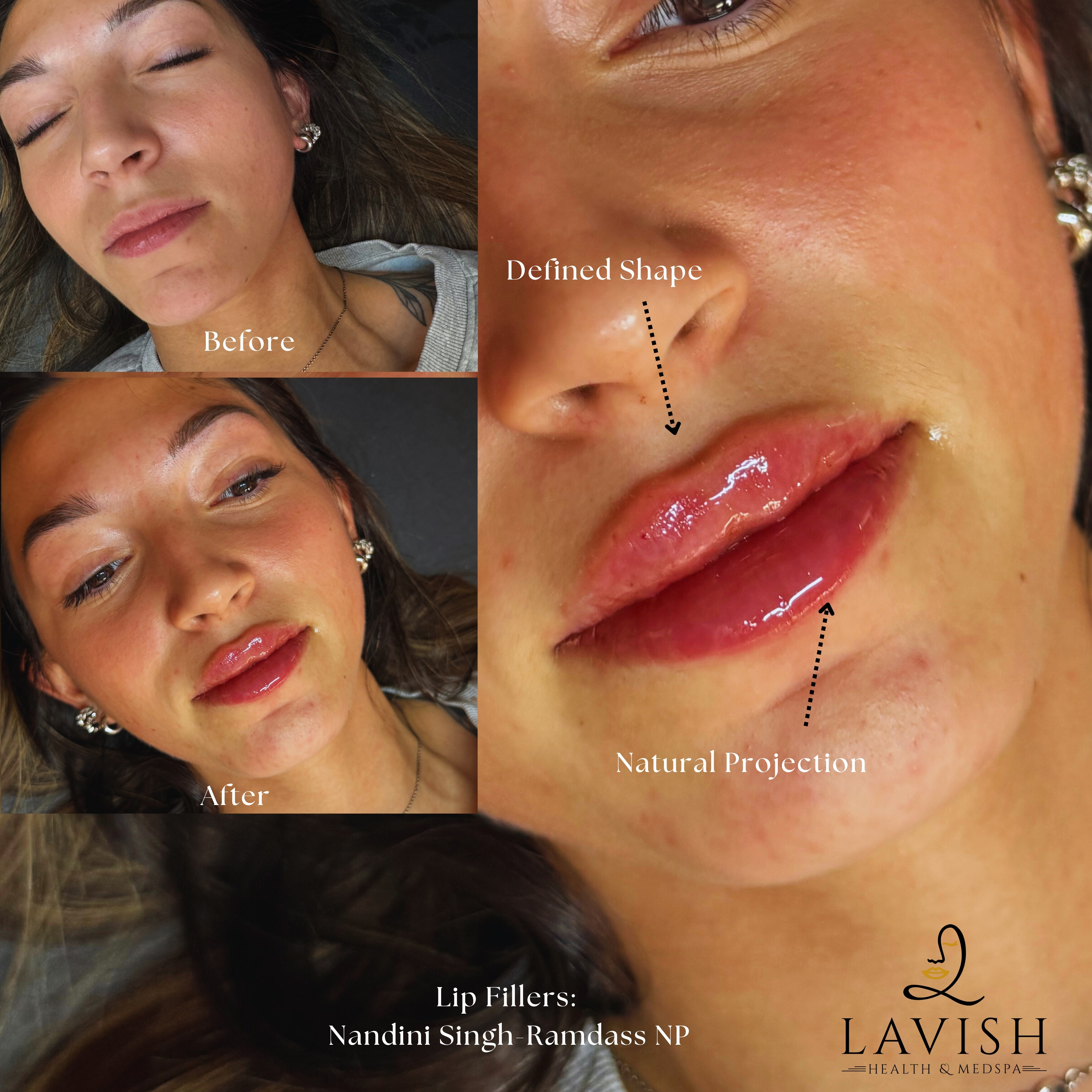 Lavish Health and MedSpa Facebook ad: LIP FILLER SPECIAL