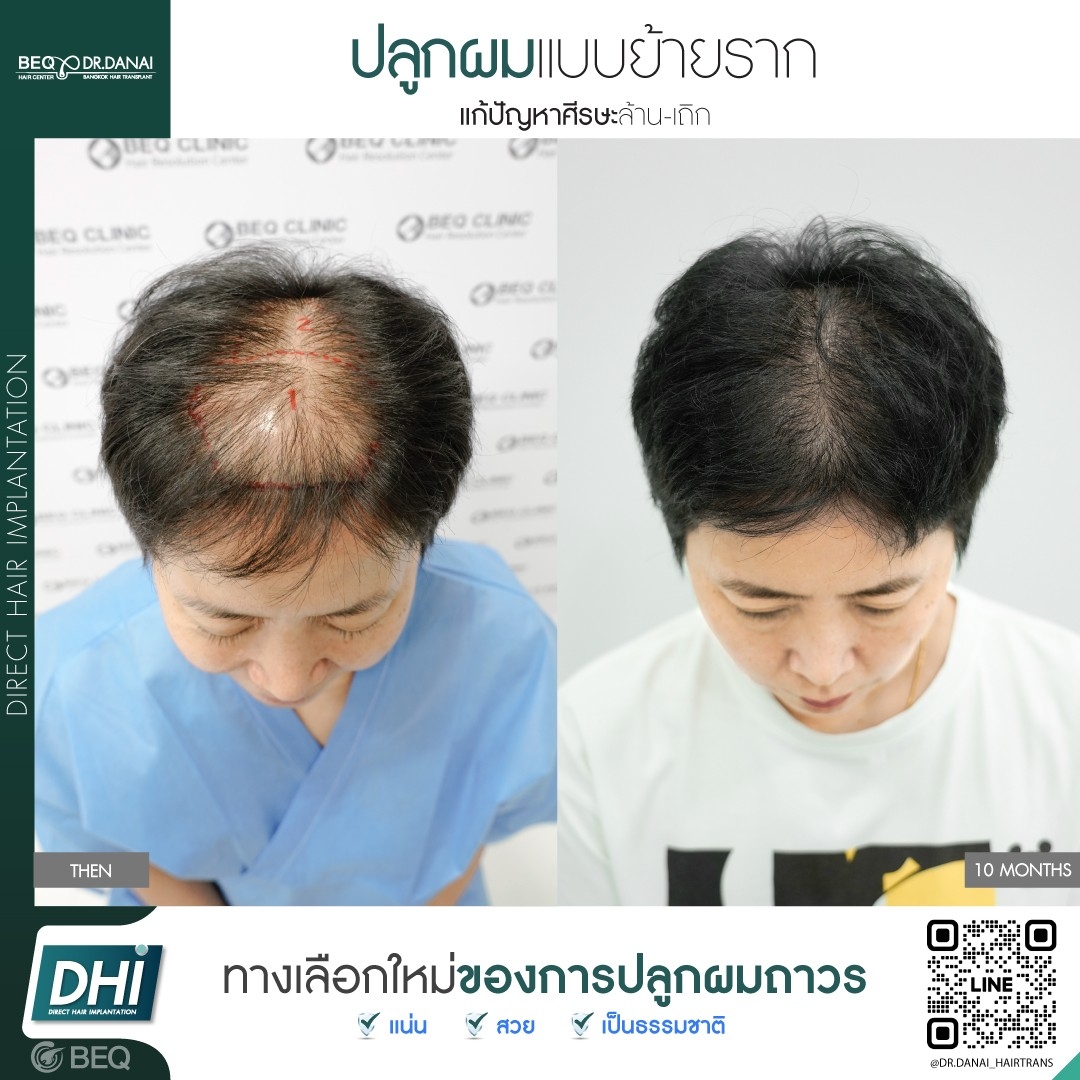 Dr. Danai Bangkok Hair Transplant ปลูกผมถาวร Facebook ad
