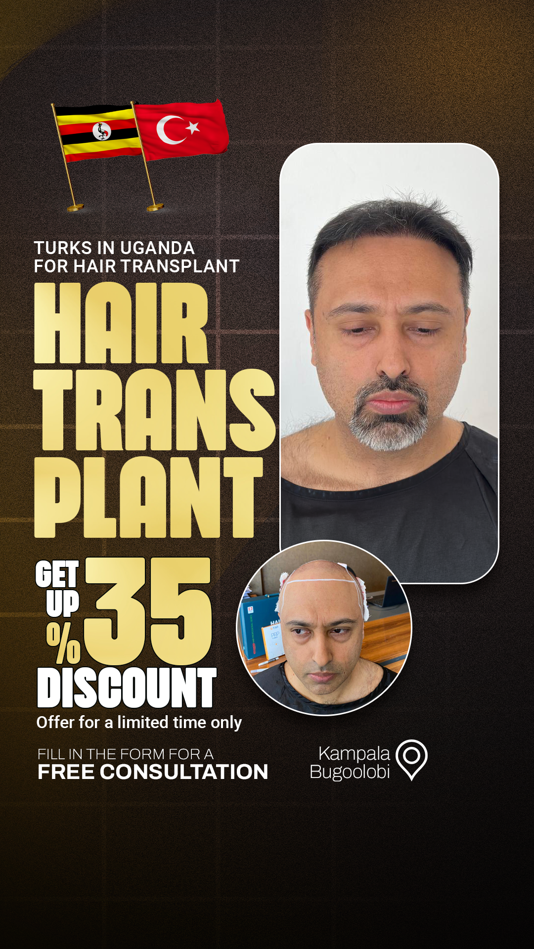 Uganda Hair Transplant Facebook ad: All Inclusive price