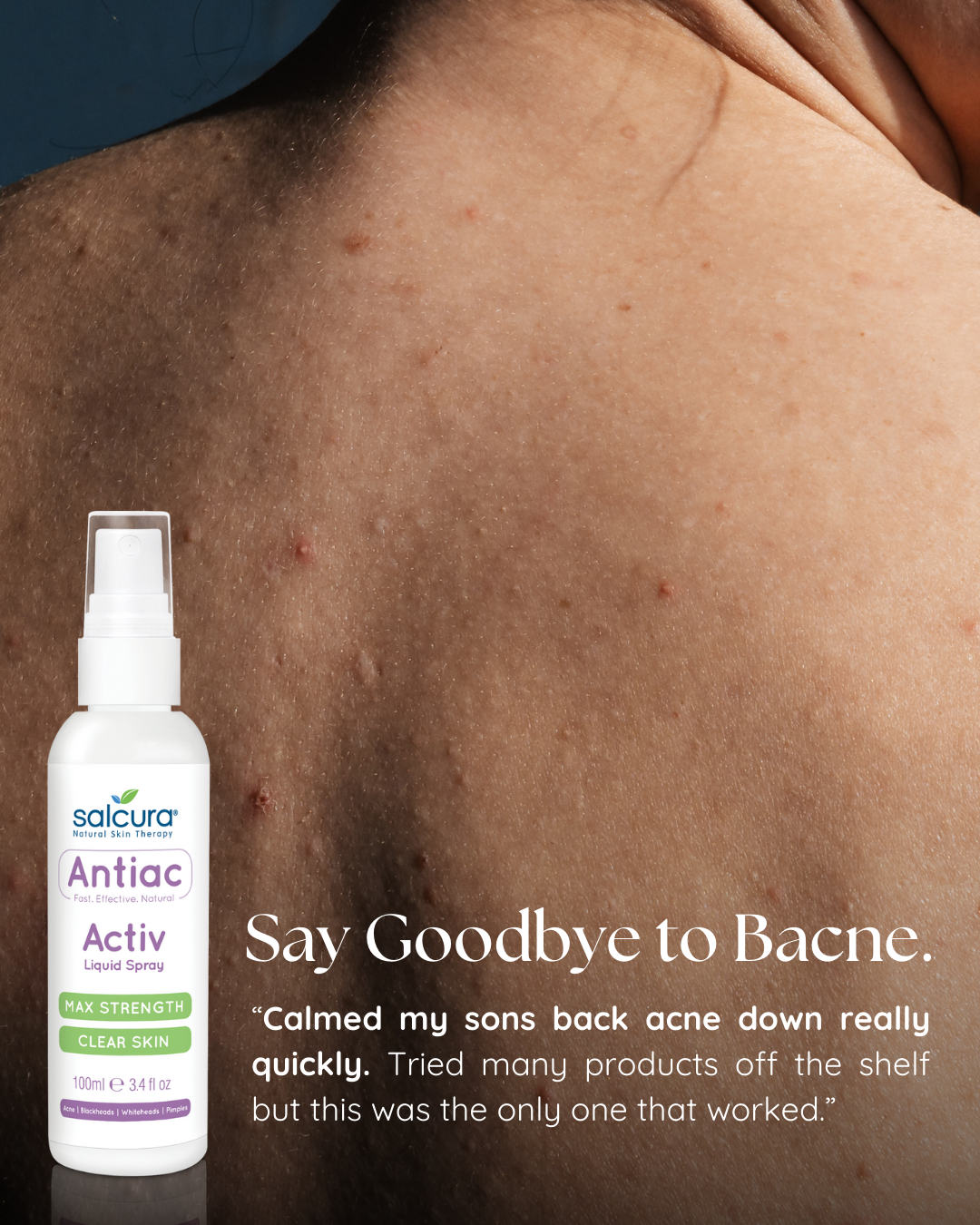 Salcura Ireland Facebook ad: Bacne, Meet Your Match!