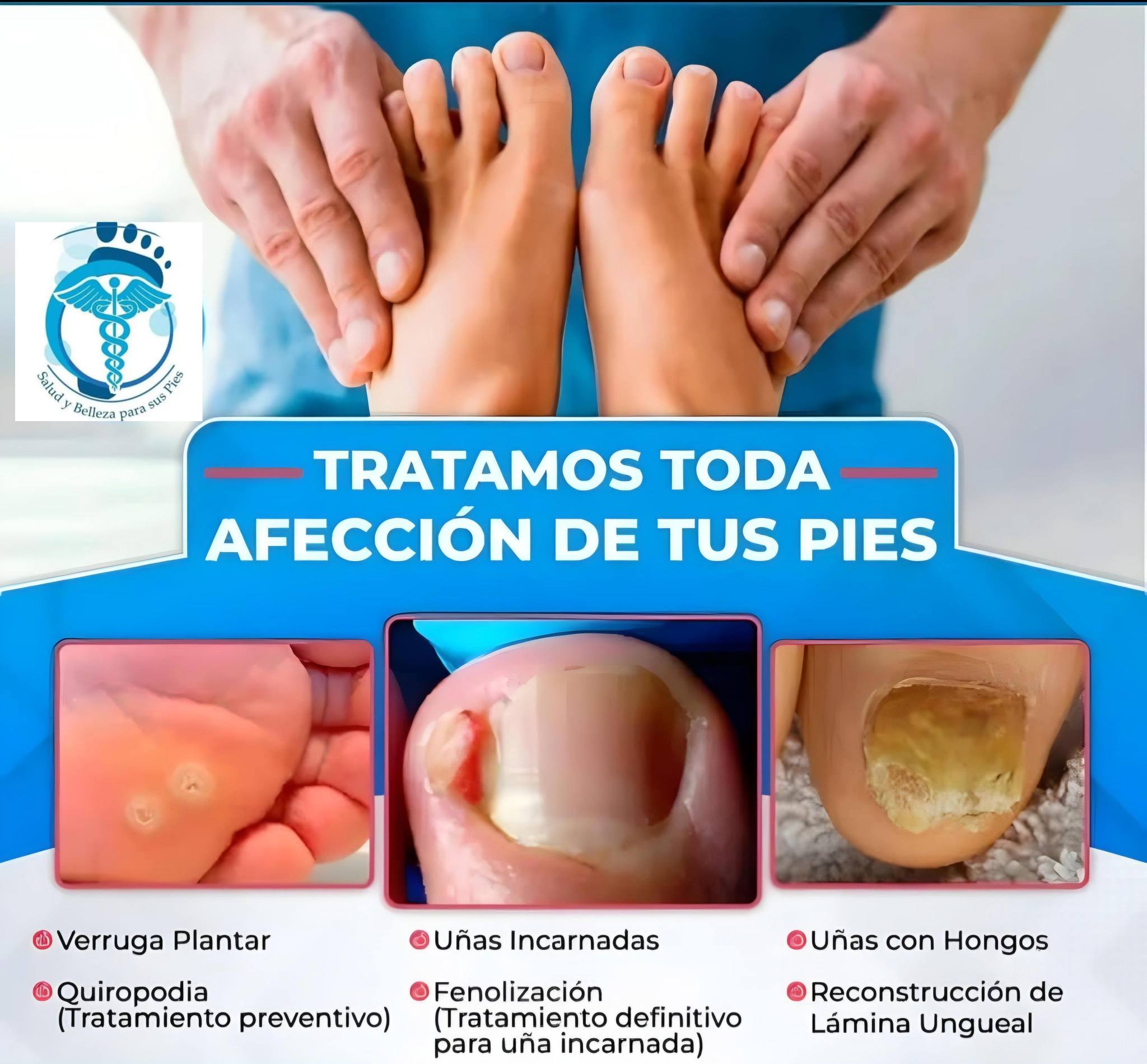 Centro de podología Dr Smith Facebook ad: ¿SUFRES DE UÑAS ENCARNADAS, HONGOS EN LAS UÑAS…