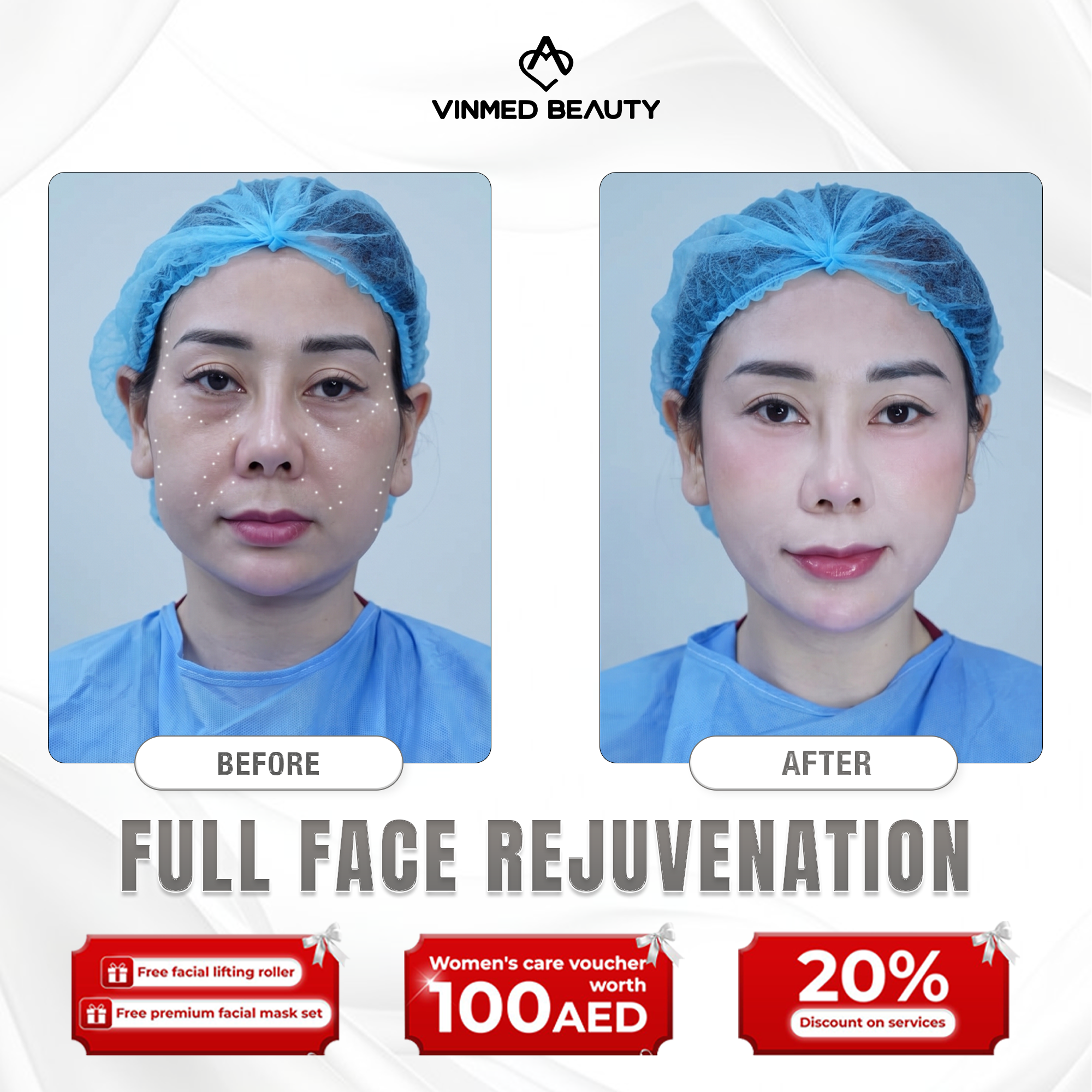 Vinmed Beauty Skin & Aesthetics - Dubai city Facebook ad: 10 years younger-full face rejuvenation