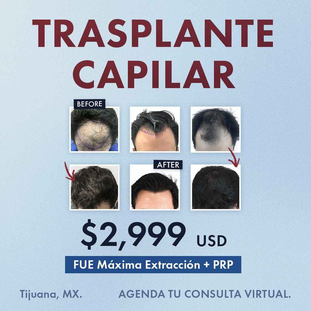 vidahaircenter Facebook ad: Trasplante Capilar FUE
