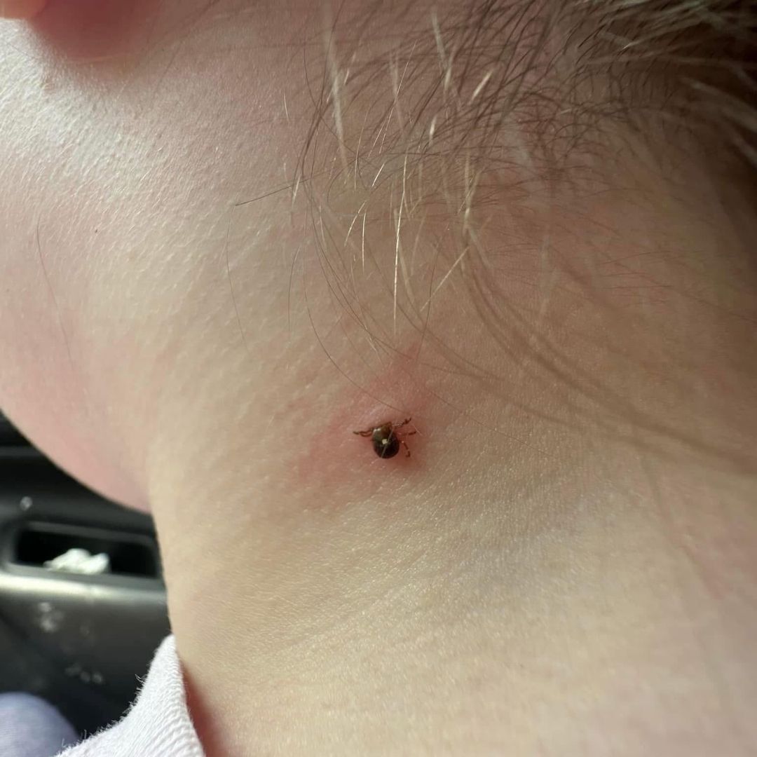 The Natural Healing Journal Facebook ad: A tick gave my 9 year old a lifelong allergy in 90…