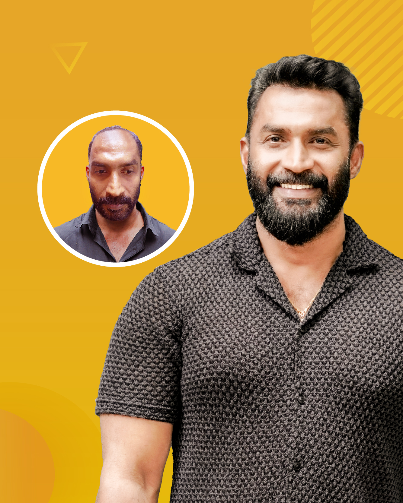 Hair Transplant India Facebook ad
