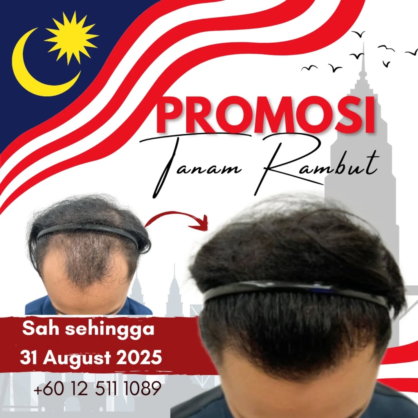 Hair Transplant Malaysia Facebook ad
