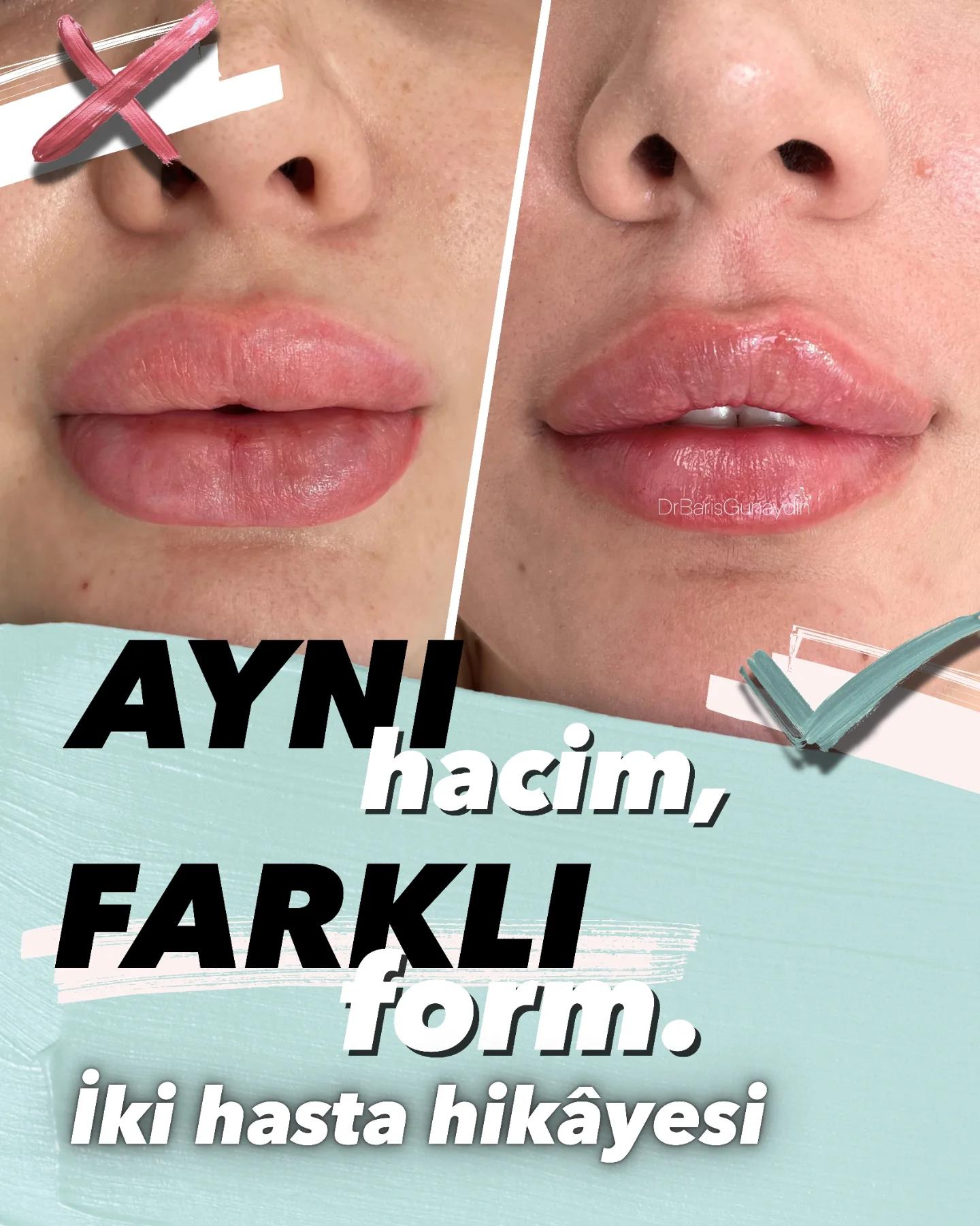 Uzm. Dr. Barış Günaydın Facebook ad: Aynı yüksek hacim, farklı sonuç.