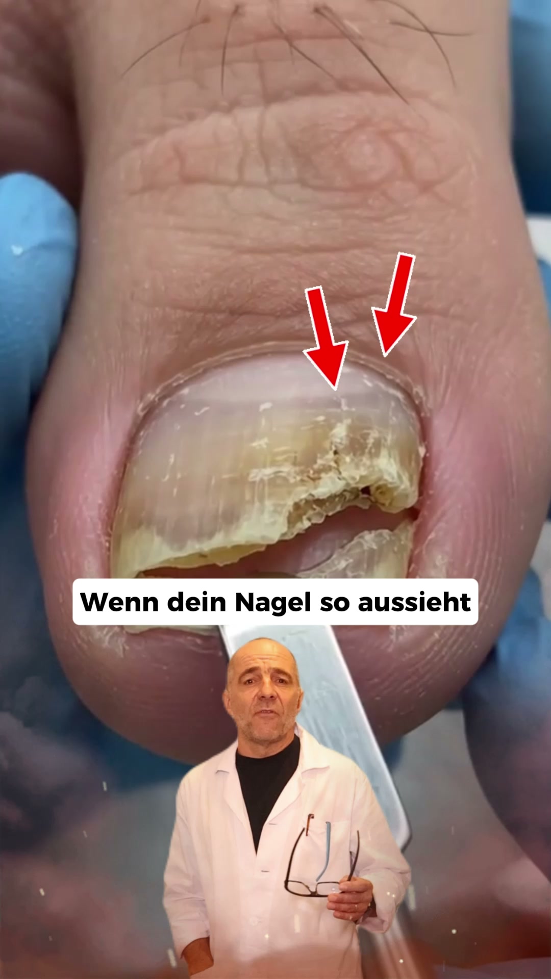 Nagelpilz Ratgeber Facebook ad: Der größte Fehler bei Nagelpilz