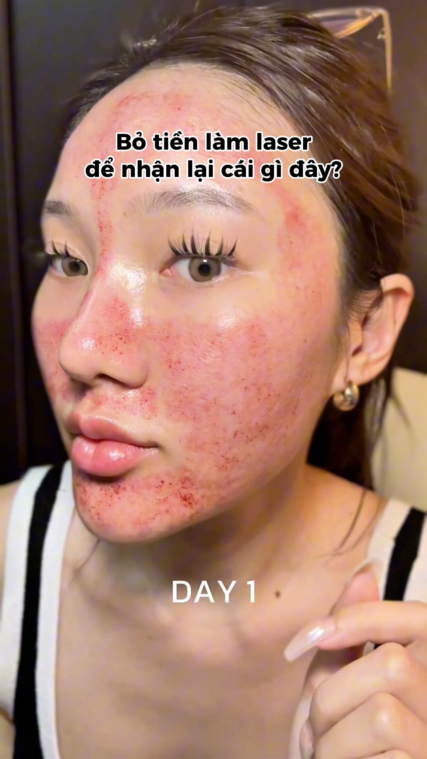 HER Clinic Facebook ad: Laser Fotona: Đánh bay thâm sẹo, thu nhỏ…