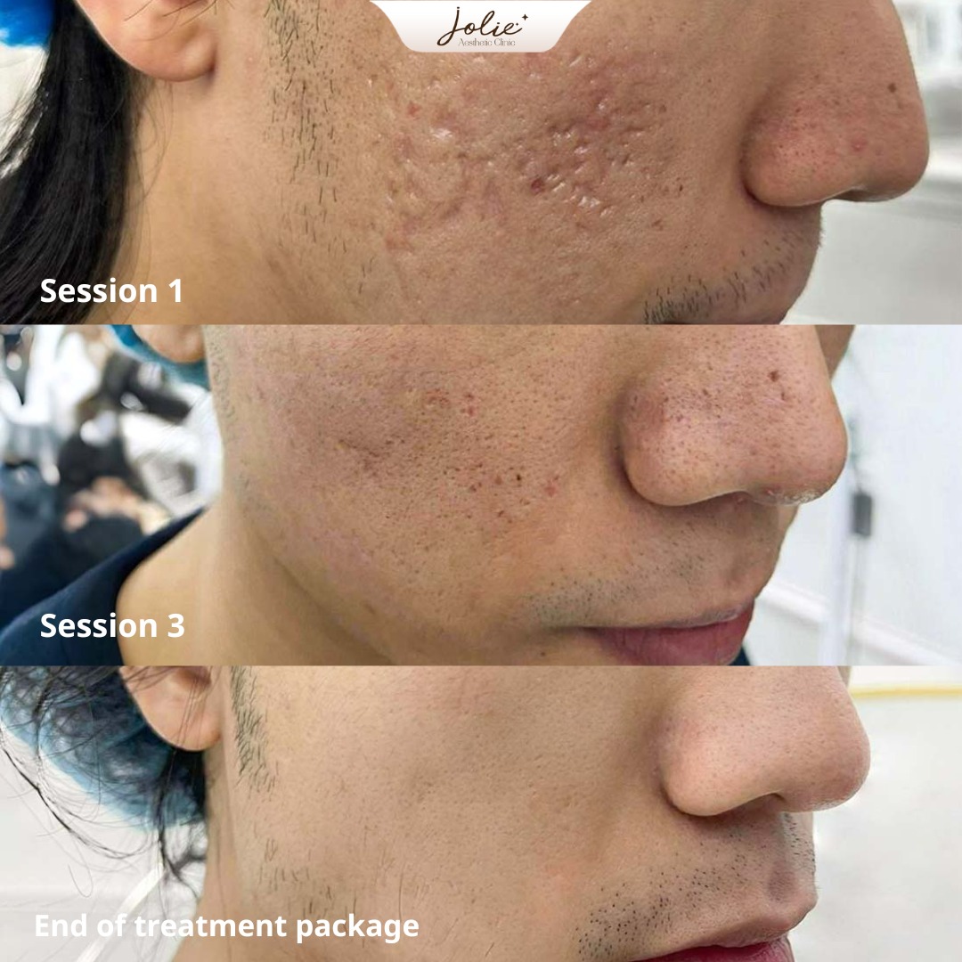 Jolie Beauty Skin Facebook ad: PITTED SCARS KILLING YOUR CONFIDENCE?