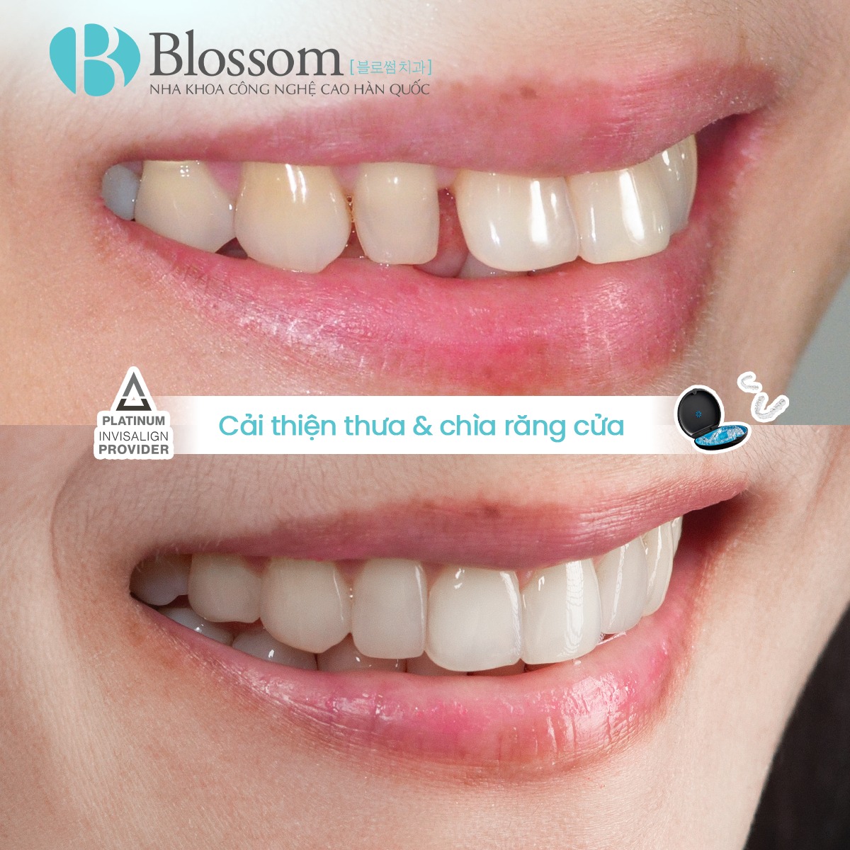 Blossom Dental Clinic - Nha Khoa Công Nghệ Cao Hàn Quốc Facebook ad