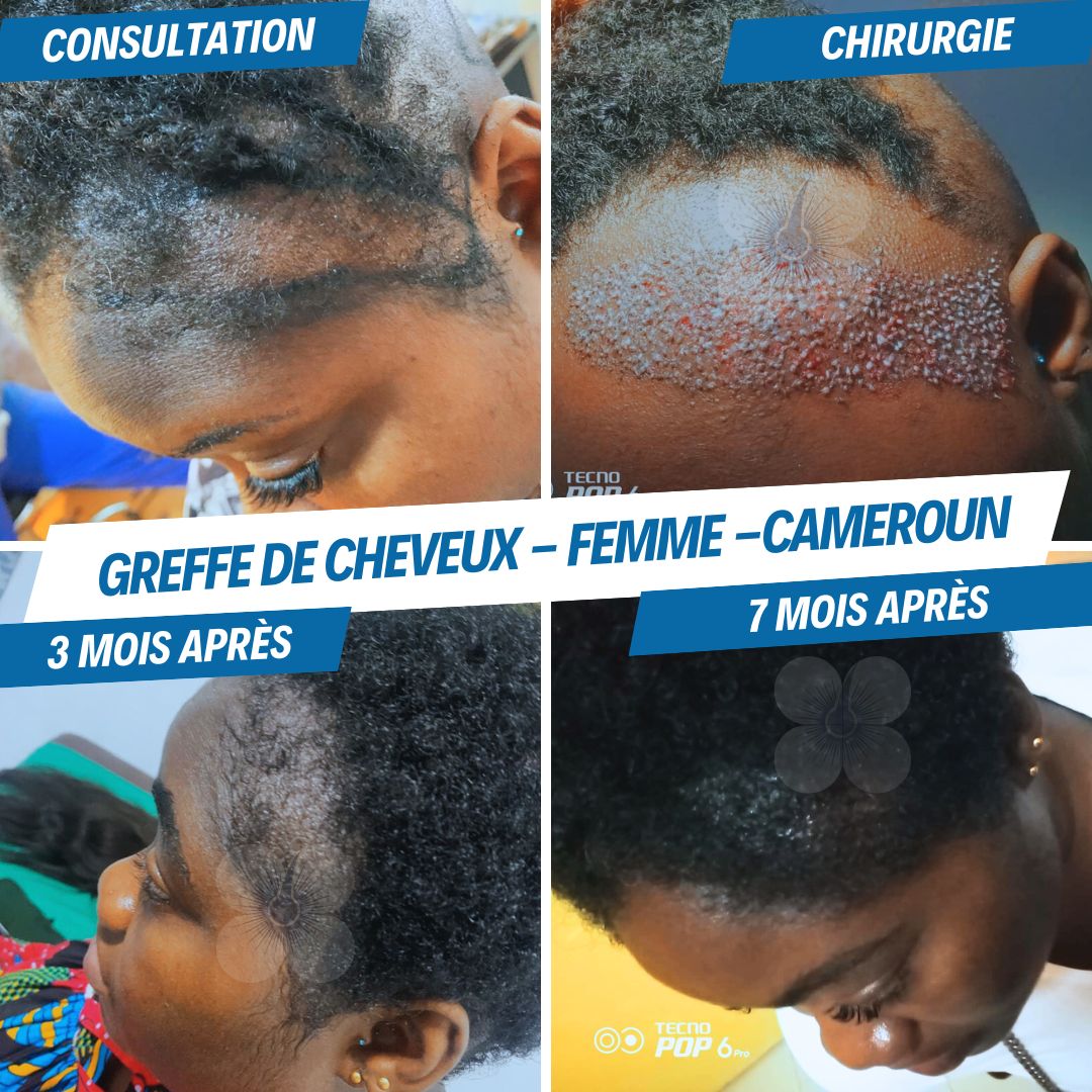 Hair Treatment Agency.Cameroon Facebook ad: Greffe de cheveux chez la femme, Cameroun