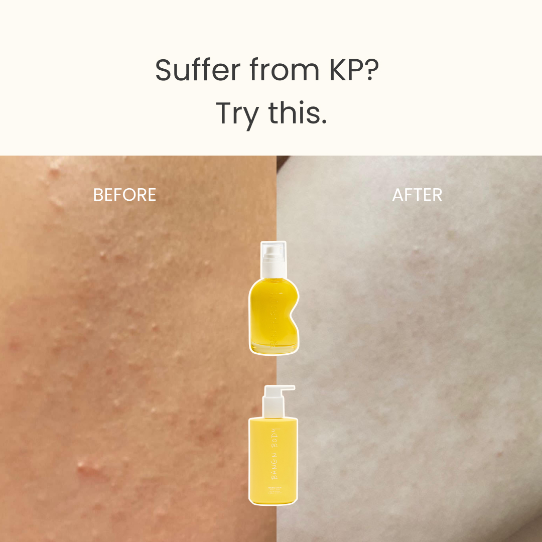 Bangn Body Facebook ad: Struggling With KP? Try This.