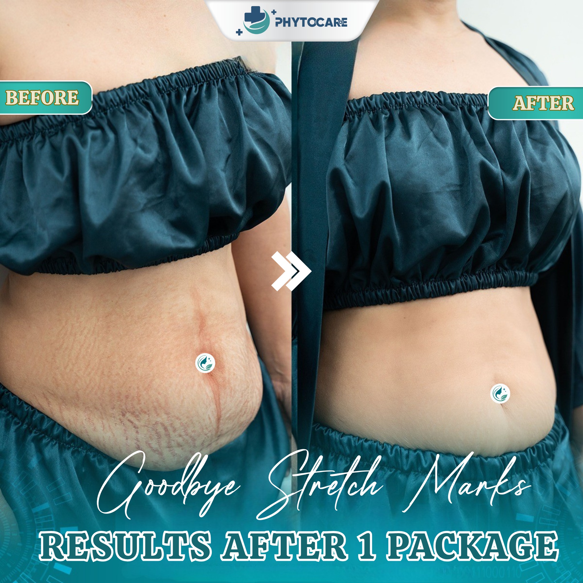 Phytocare Dermatology Cebu Facebook ad: STRETCH MARKS AFTER PREGNANCY OR WEIGHT CHANGES?