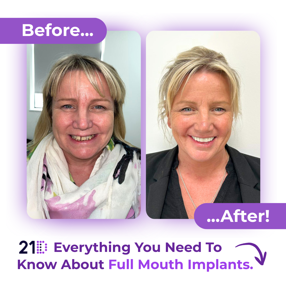 21D: Exclusively Full Jaw Implant Solutions Facebook ad