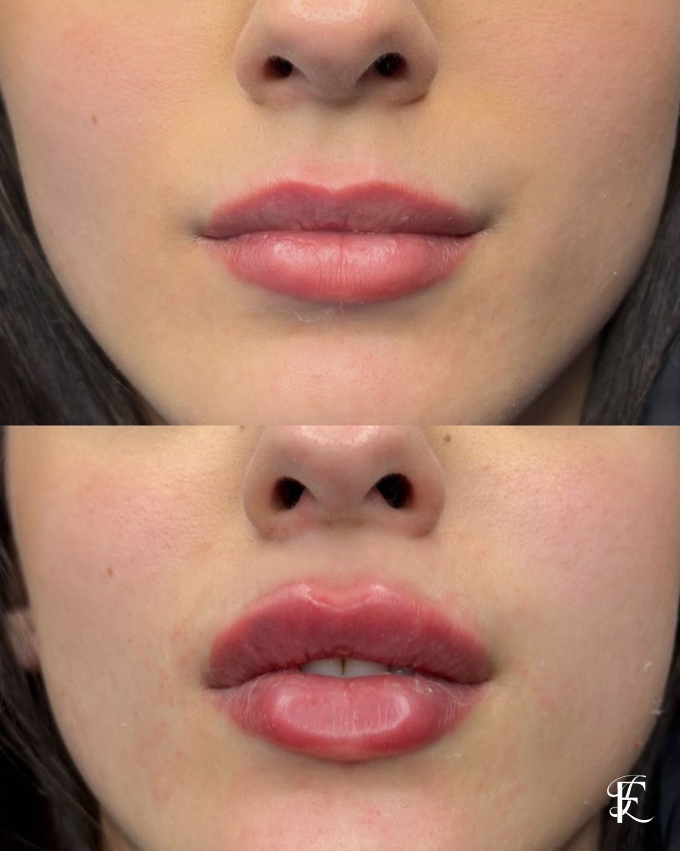 Dr Lautaro Franco Aesthetic Medicine Facebook ad: Los Russian Lips redefinen el labio, aportando altura…