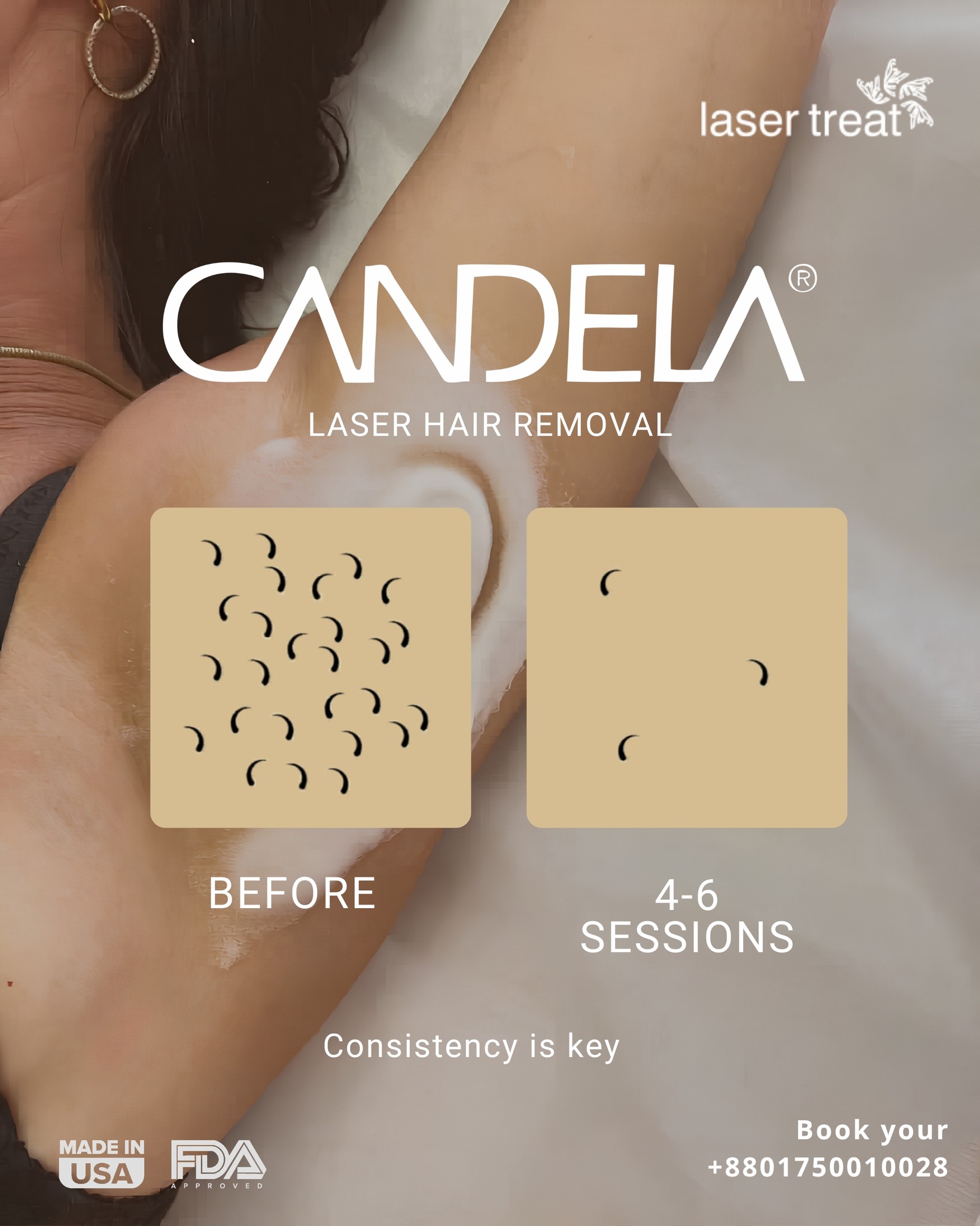 LaserTreat Facebook ad: Smooth skin doesn't happen overnight-consistency is the…