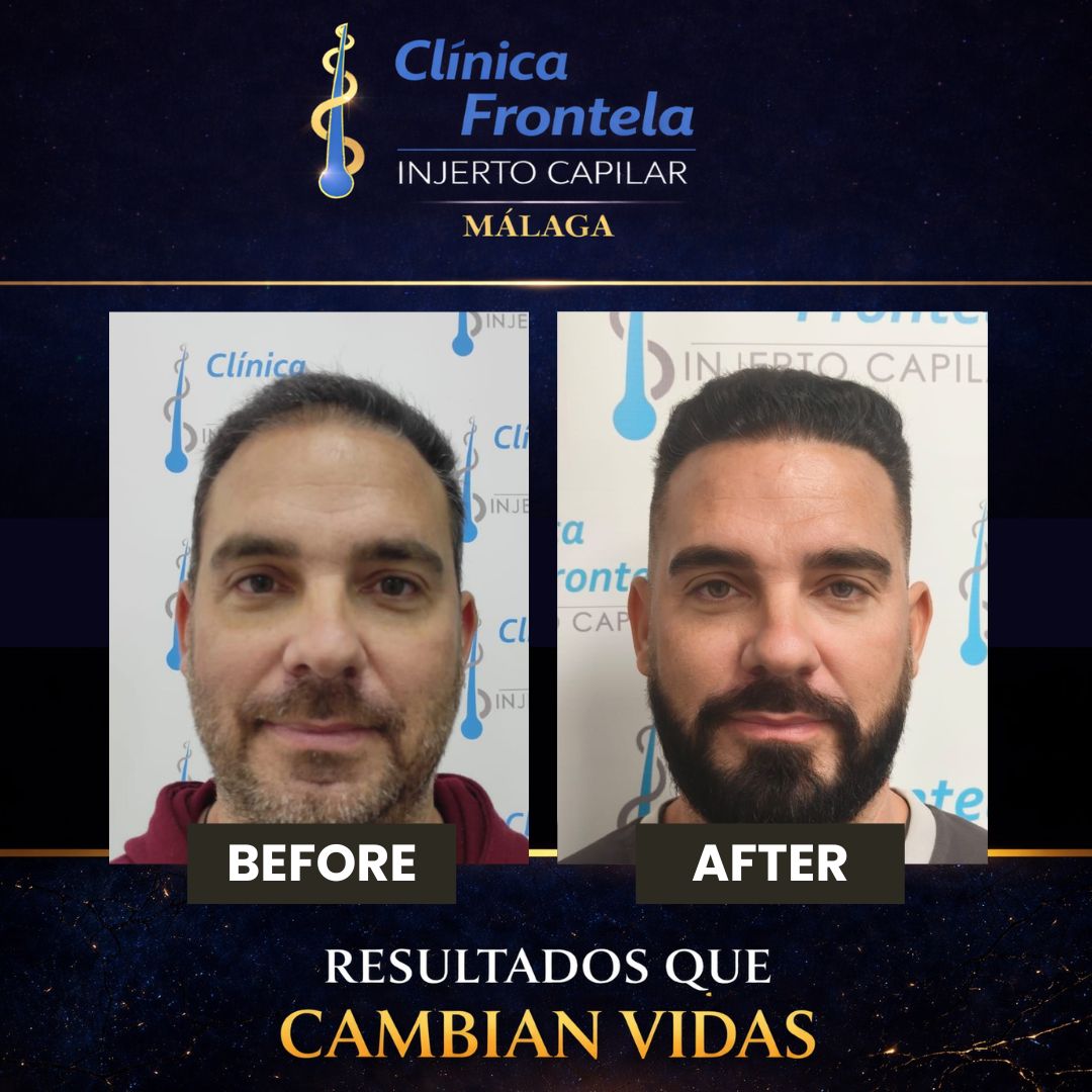 Clinica Injerto Capilar Frontela Facebook ad