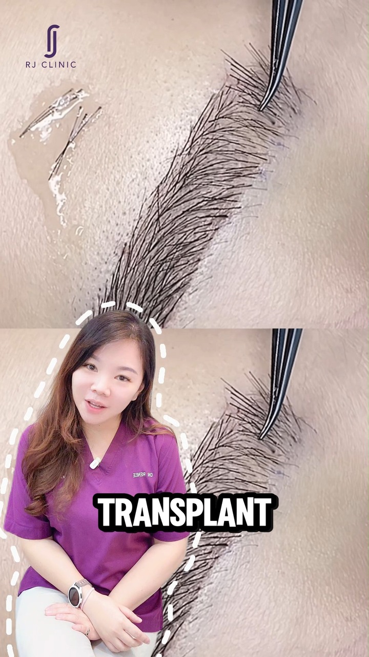 RJ Clinic Skin, Laser & Aesthetic Clinic Malaysia Facebook ad: What happens after an eyebrow transplant?