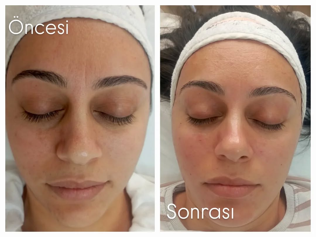 Newvolume aydın güzellik salonu Facebook ad: Cildin nefes alsın, ışıltın ortaya çıksın!
