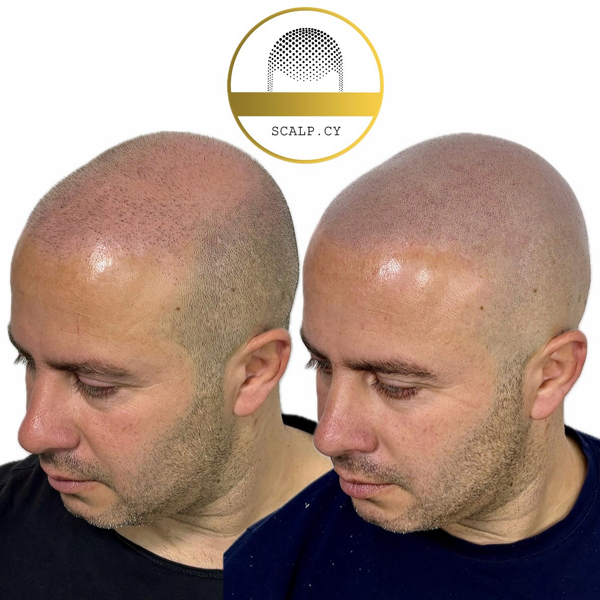 Scalp Micropigmentation Cyprus Facebook ad: SMP after failed hair transplant.
