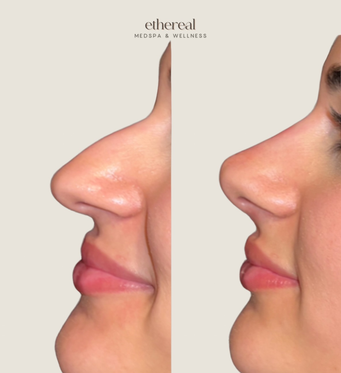 derm.mash Facebook ad: After a liquid rhinoplasty and Botox