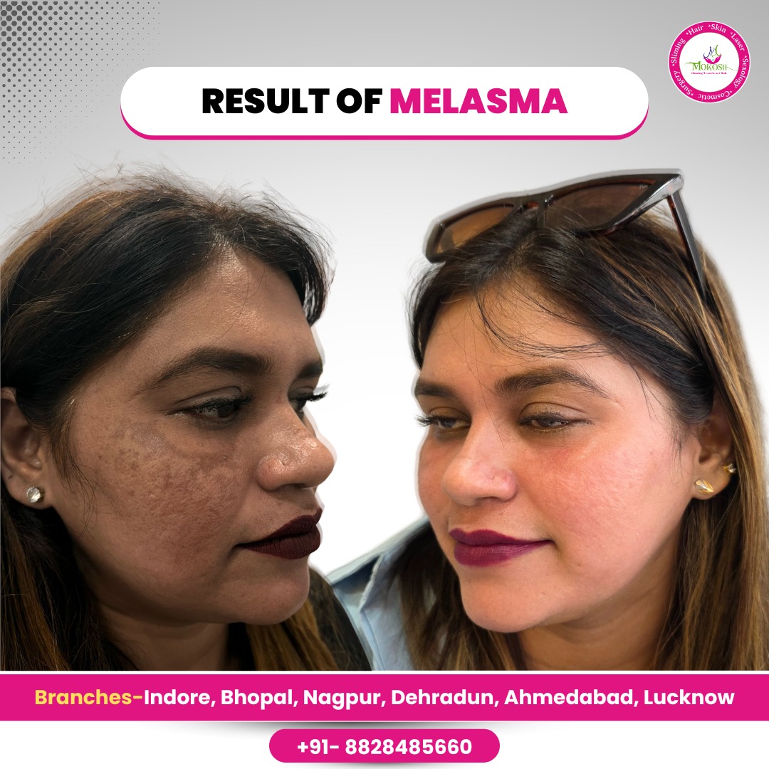 Mokosh Hair Grow Clinic Facebook ad: Struggling with melasma or dark patches on your…