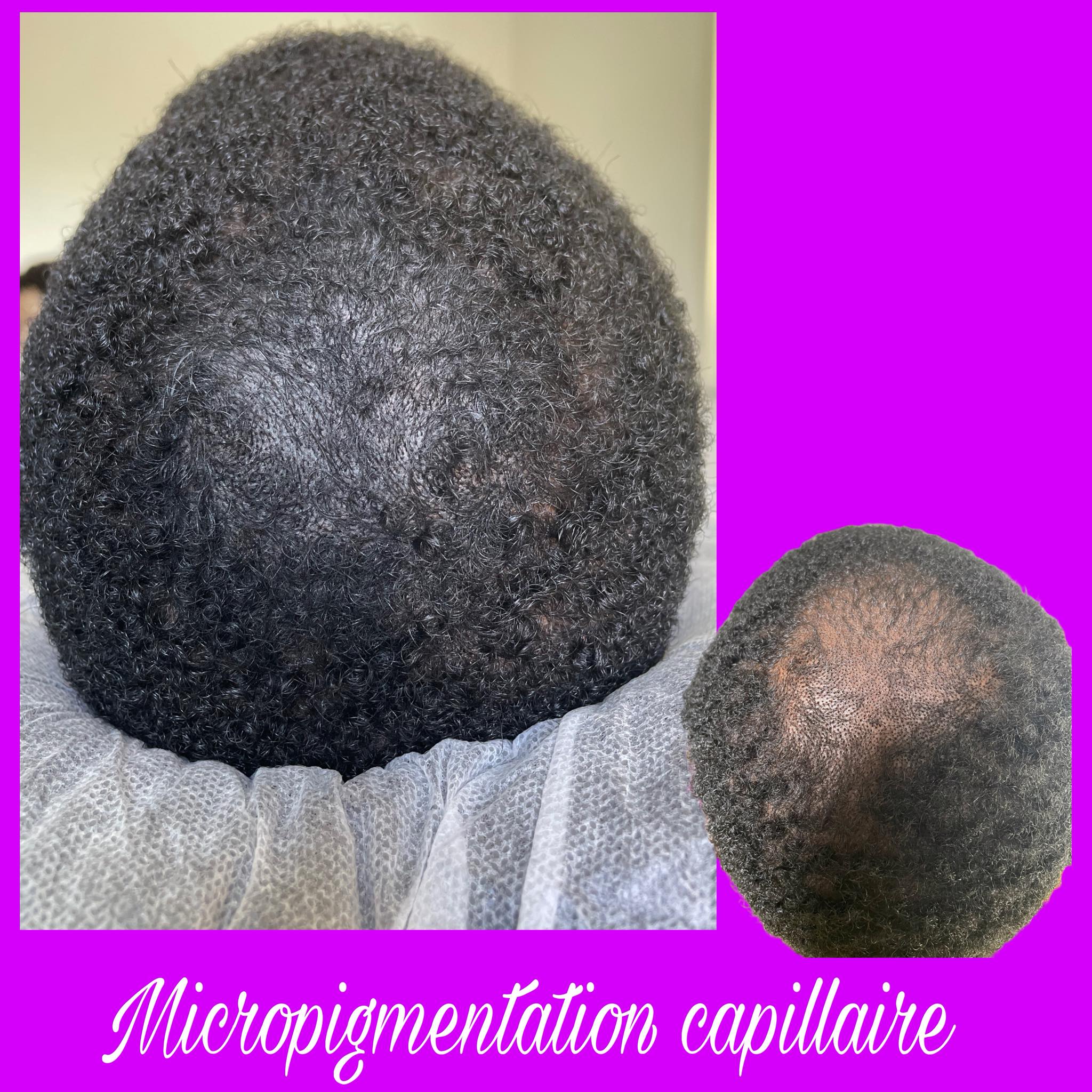Nouvel Hair Clinic Facebook ad: Calvitie, alopécies ou perte de densité capillaire?