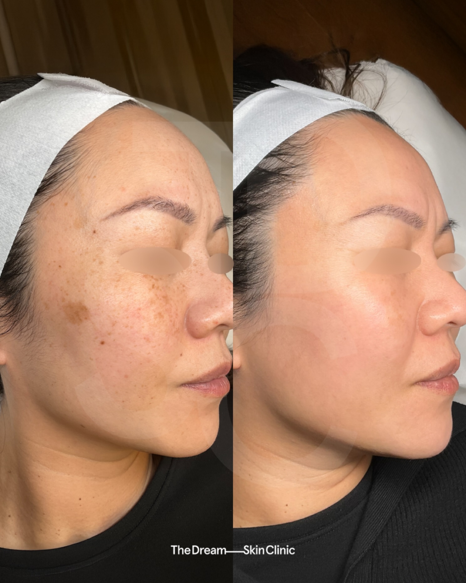 The Dream Skin Clinic Facebook ad: Reputation for Results Our client completed a tailored…