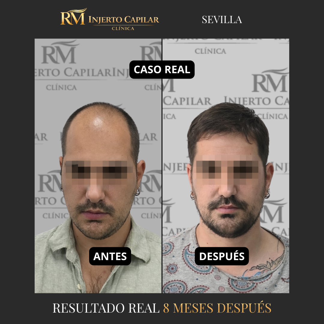 RM Injerto Capilar Facebook ad: Resultados reales de injerto capilar