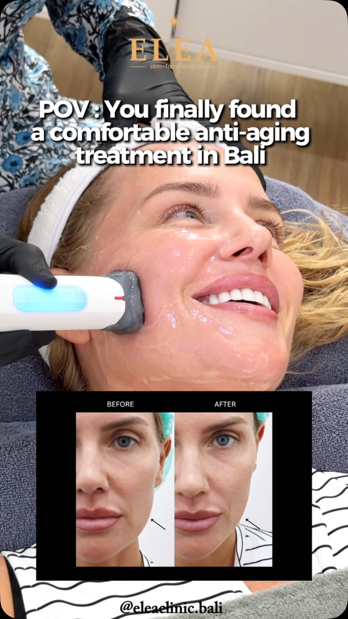Elea Clinic Bali Facebook ad: World-class skincare. Right here in Bali.