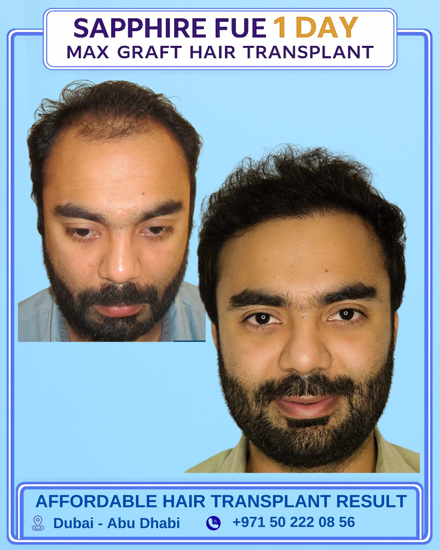 Affordable Max FUE Hair Transplant Facebook ad: AFFORDABLE MAX GRAFTS FUE HAIR TRANSPLANT
