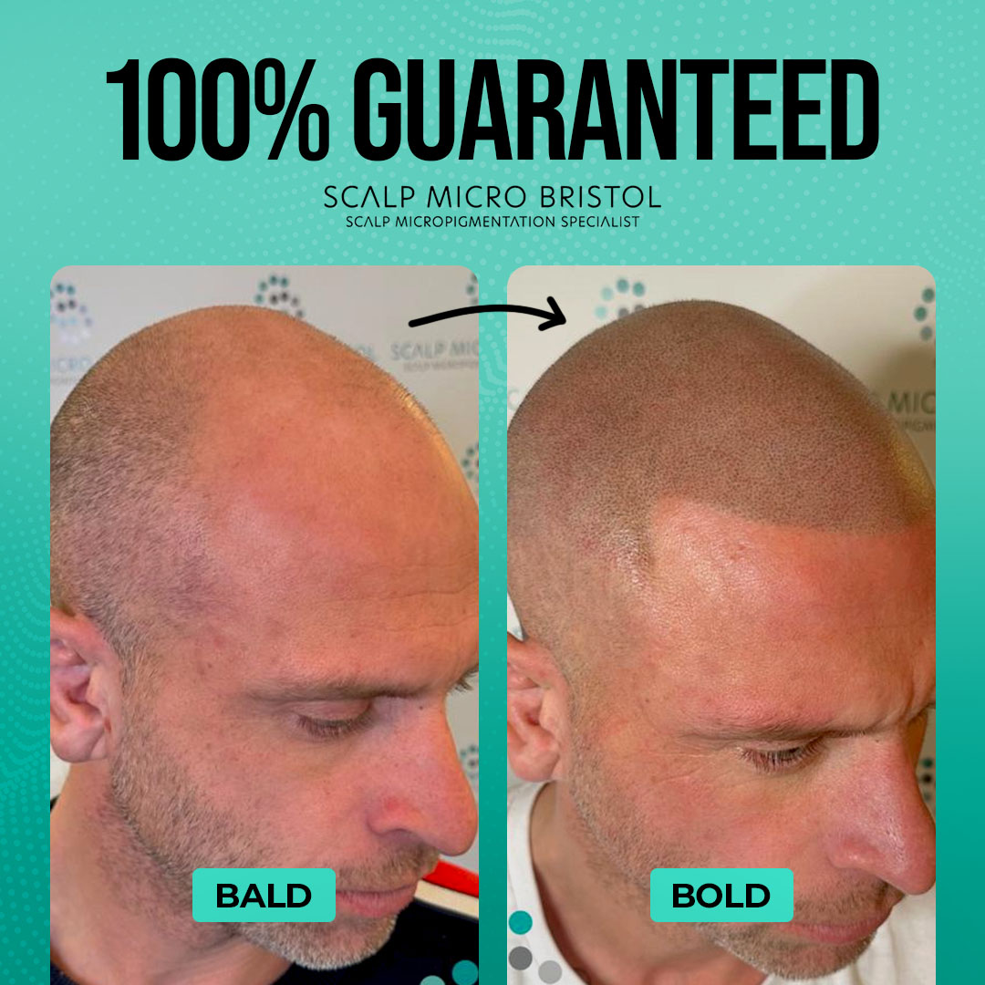 Scalp Micro Bristol Facebook ad: Bristol- 15% Off Scalp Micropigmentation