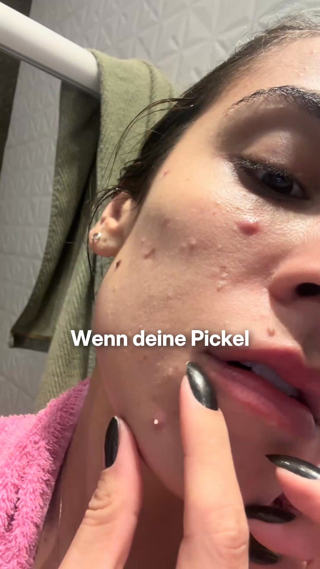 Alex Nolte Facebook ad: Sommer-Pickel jetzt schon loswerden
